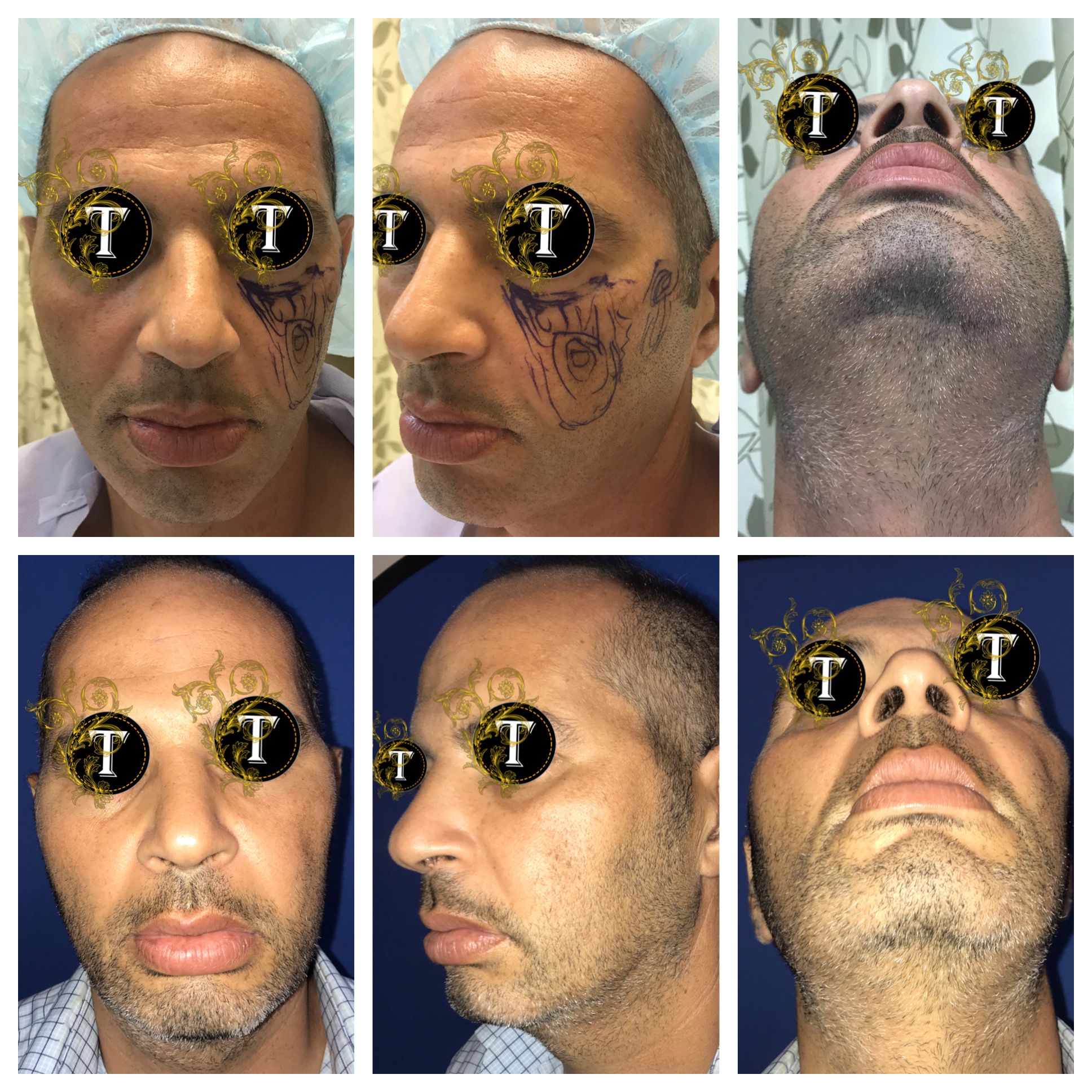 Cheek Augmentation in Ft. Lauderdale