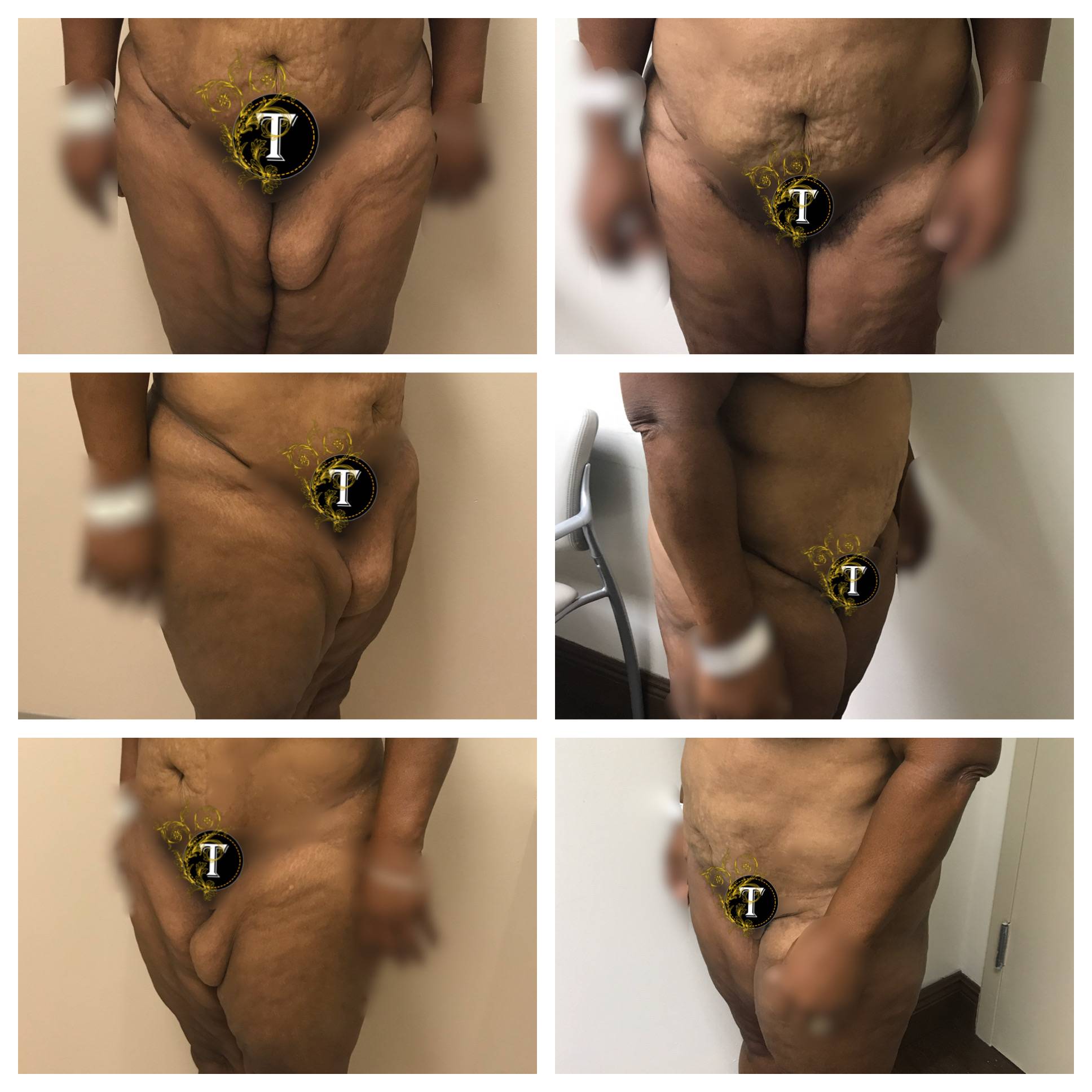 Thigh Lift in Ft. Lauderdale