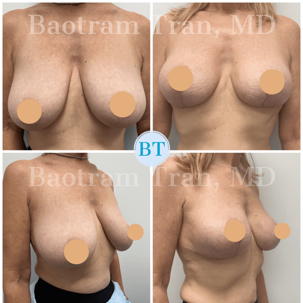 Breast Lift Without Implant