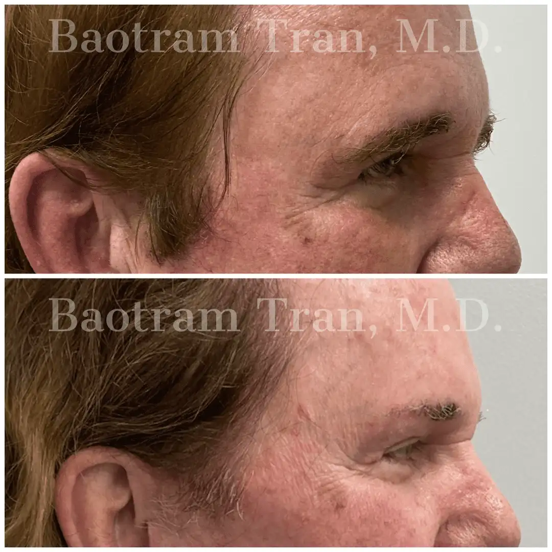 Before and After Image: Brow Lift - right-side