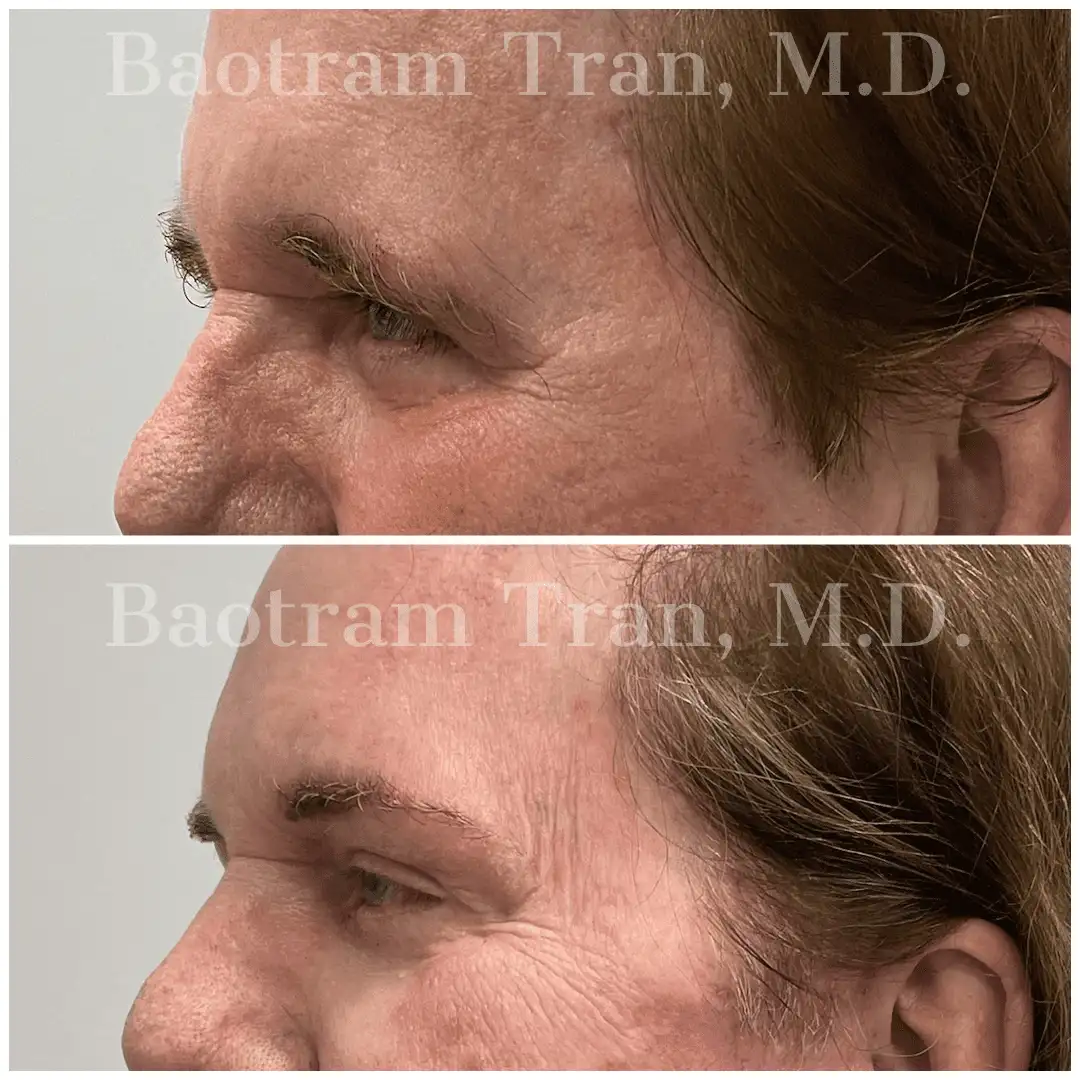 Before and After Image: Brow Lift - left-front-oblique