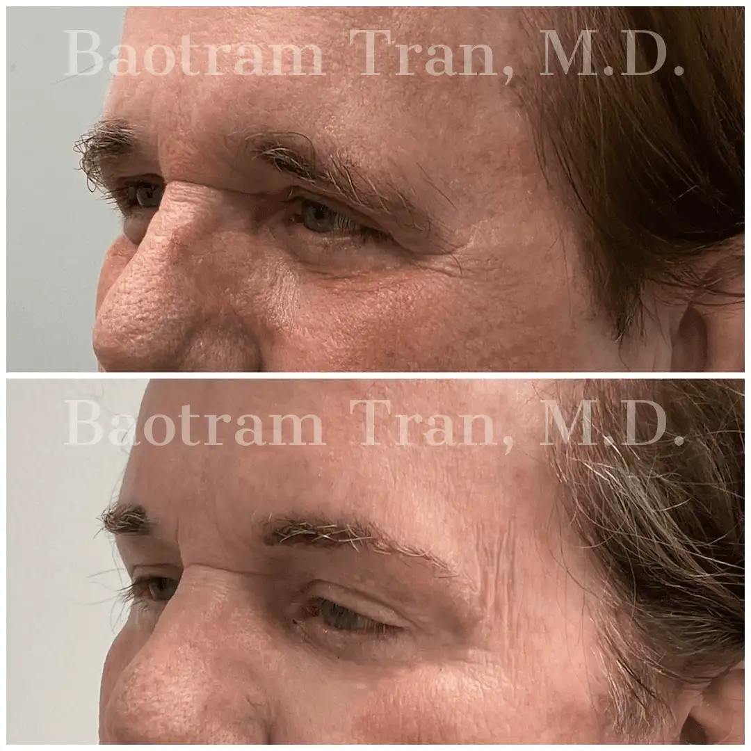 Before and After Image: Brow Lift - left-front-oblique
