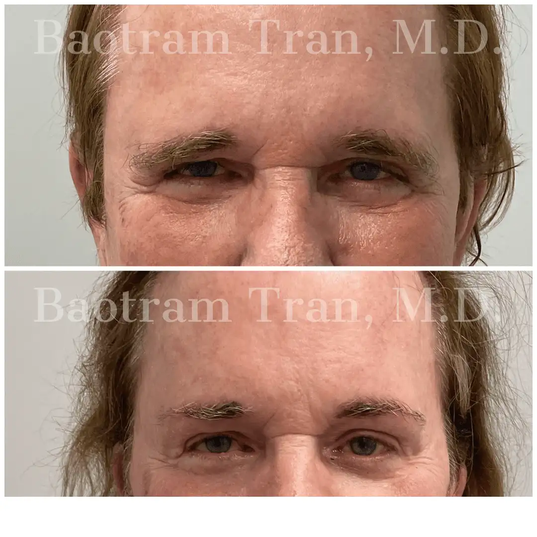Before and After Image: Brow Lift - front