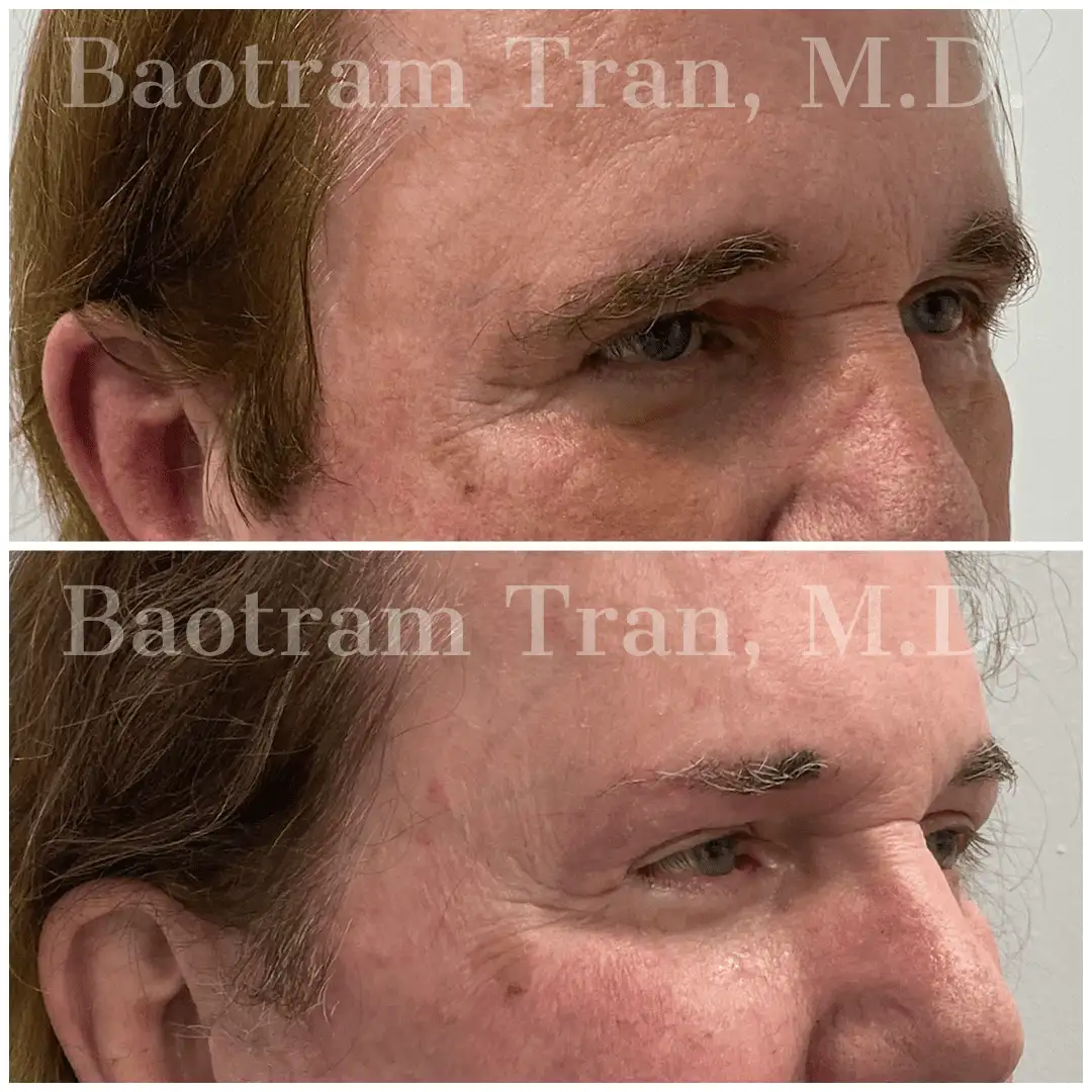 Before and After Image: Brow Lift - right-front-oblique