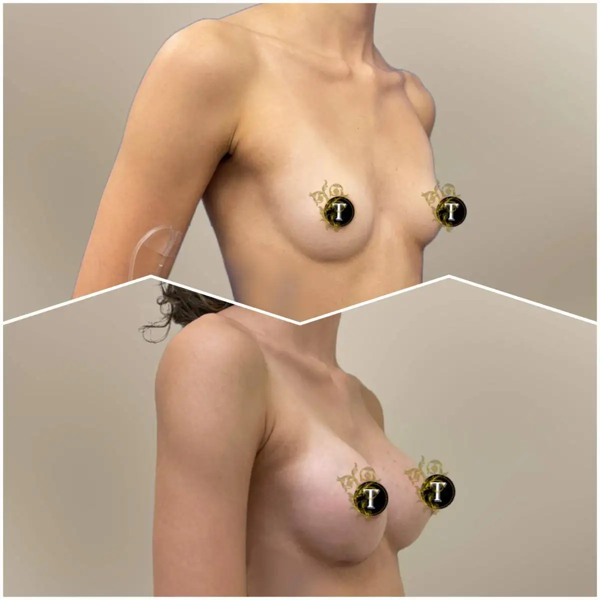 Before and After Image: Breast Augmentation - right-front-oblique