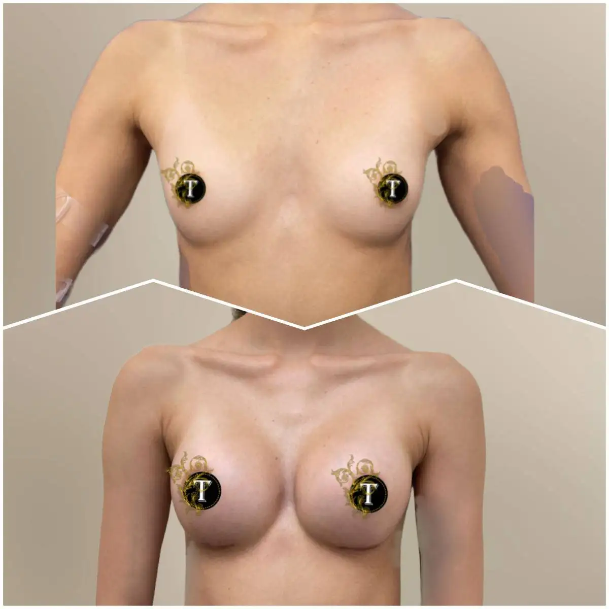 Before and After Image: Breast Augmentation - front