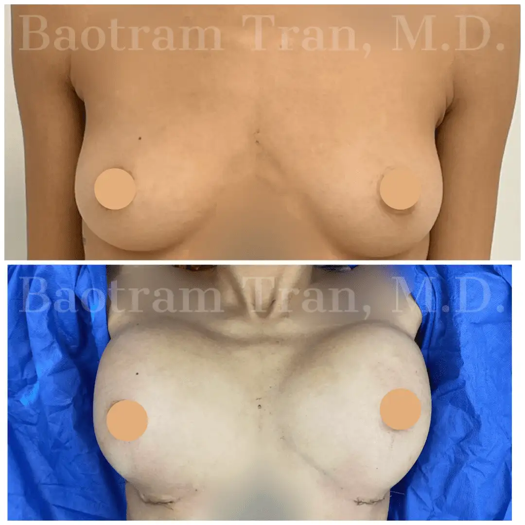 Before and After Image: Breast Augmentation - front