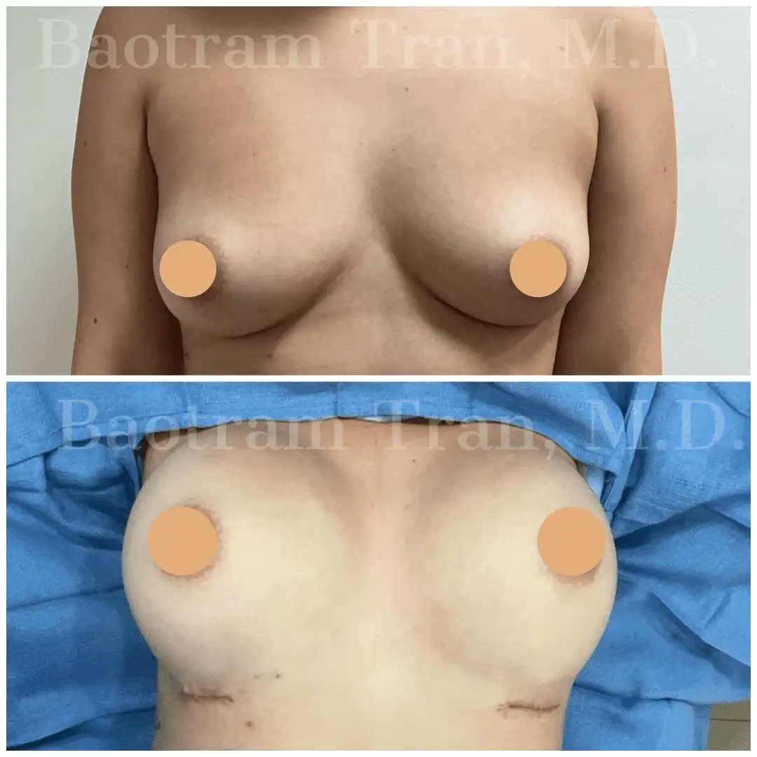 Before and After Image: Breast Augmentation - front
