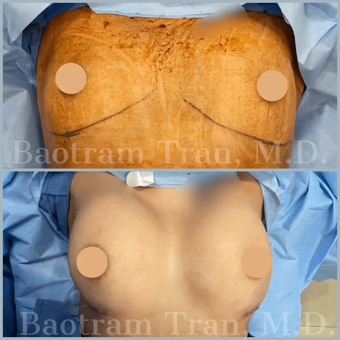 Before and After Image: Breast Augmentation - front