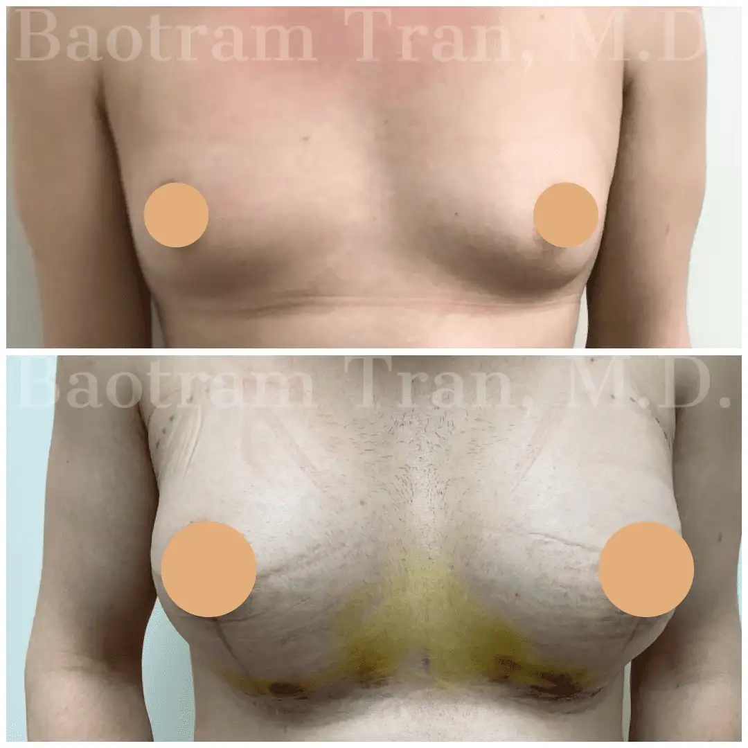 Before and After Image: Breast Augmentation - front