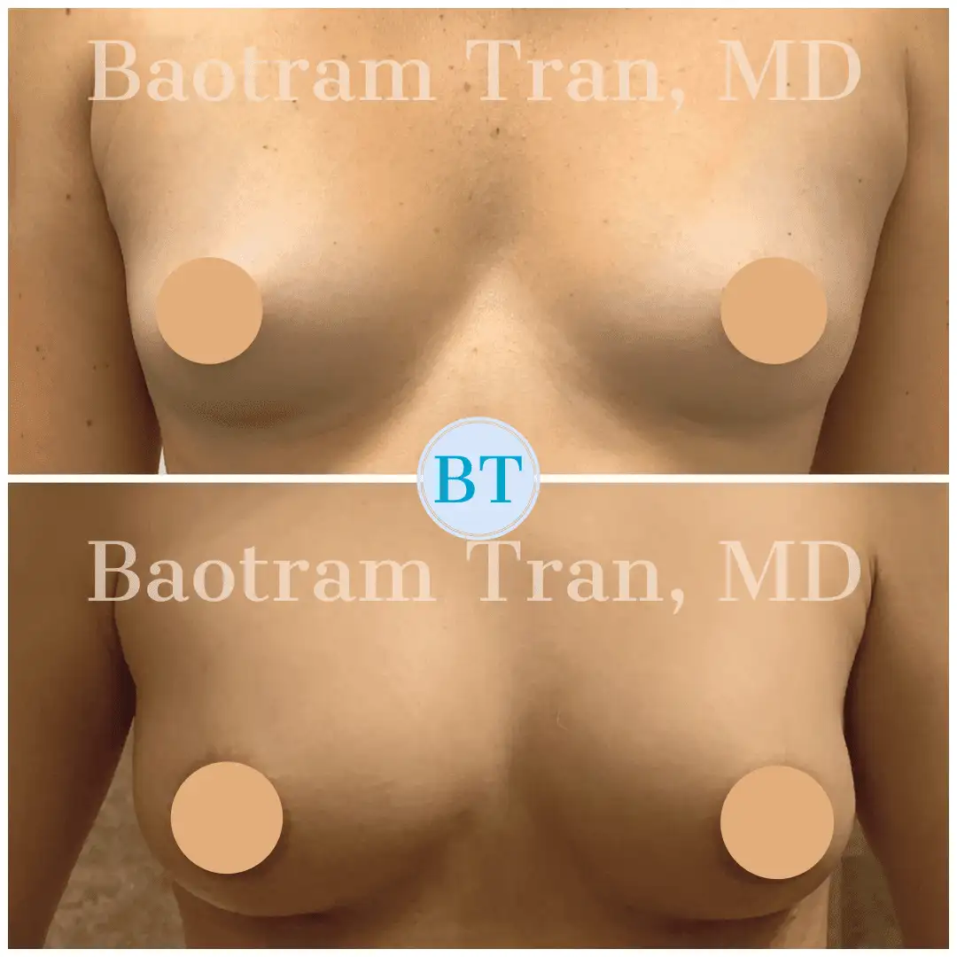 Before and After Image: Breast Augmentation - front