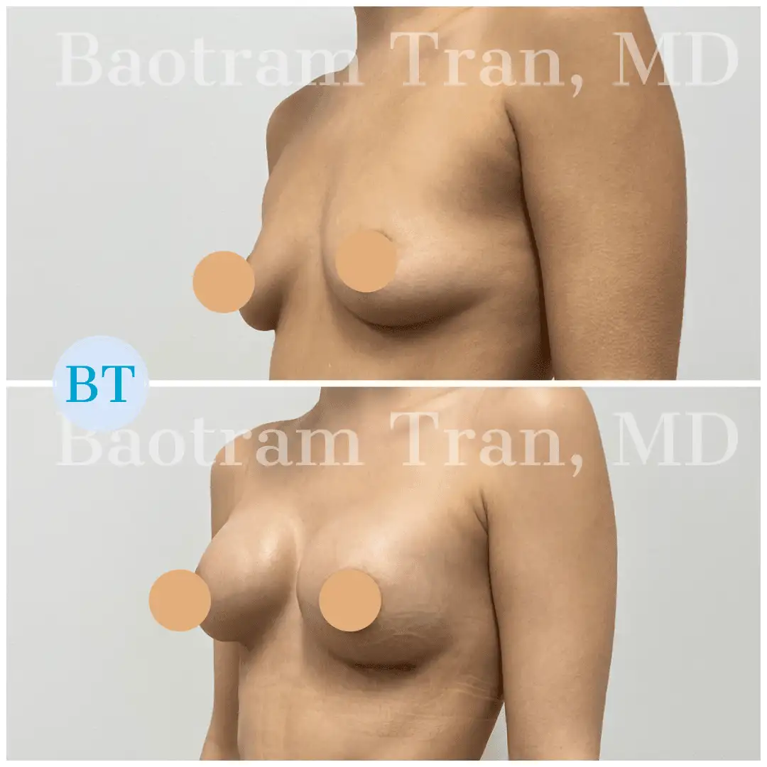 Before and After Image: Breast Augmentation - left-front-oblique