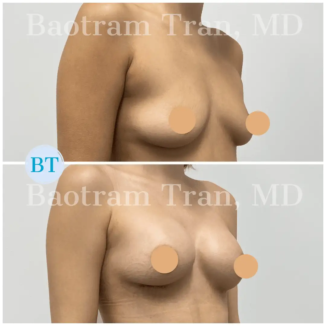 Before and After Image: Breast Augmentation - right-front-oblique