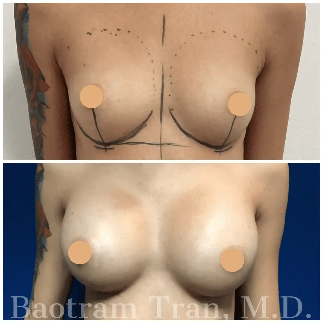 Before and After Image: Breast Augmentation - front