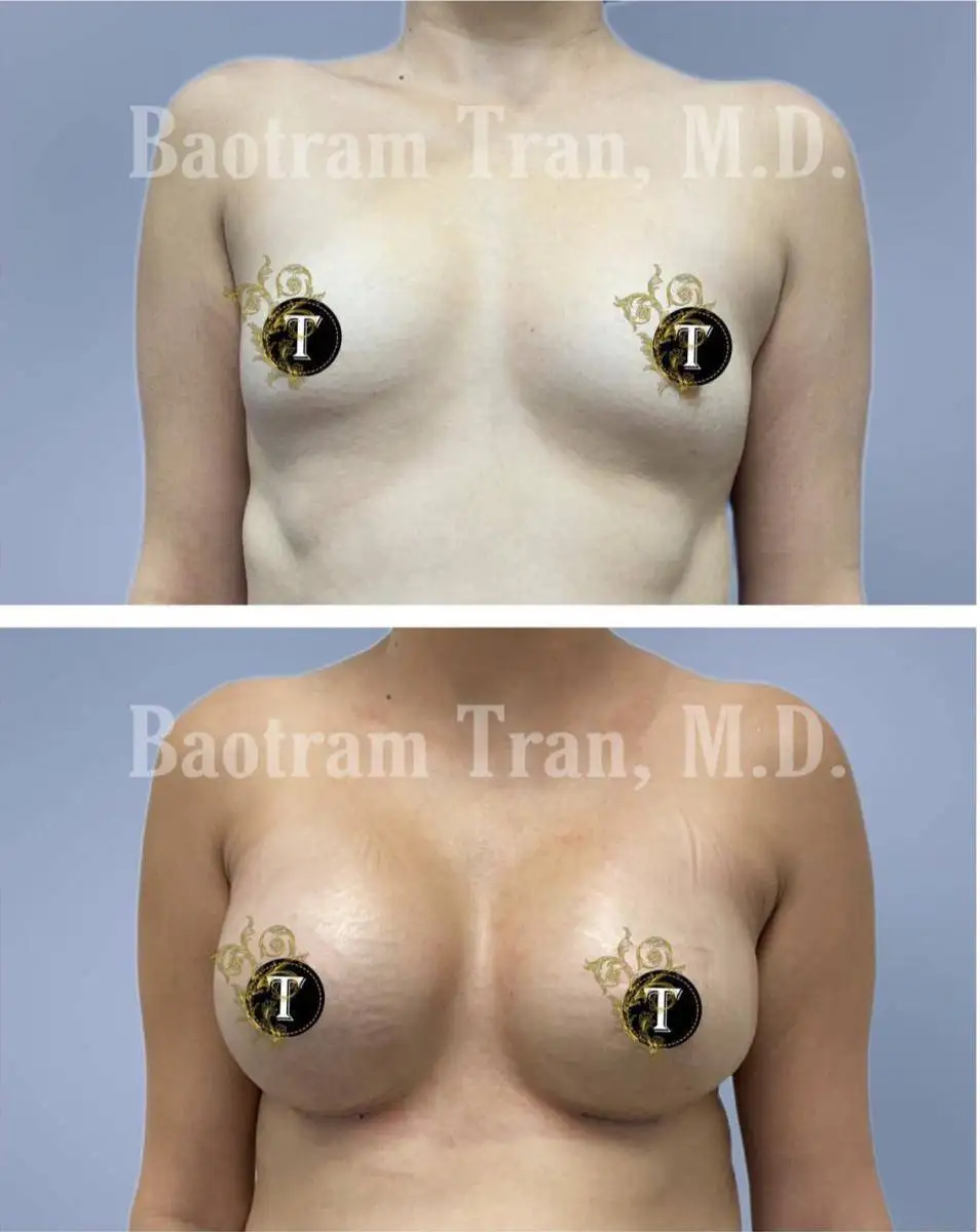 Before and After Image: Breast Augmentation - front
