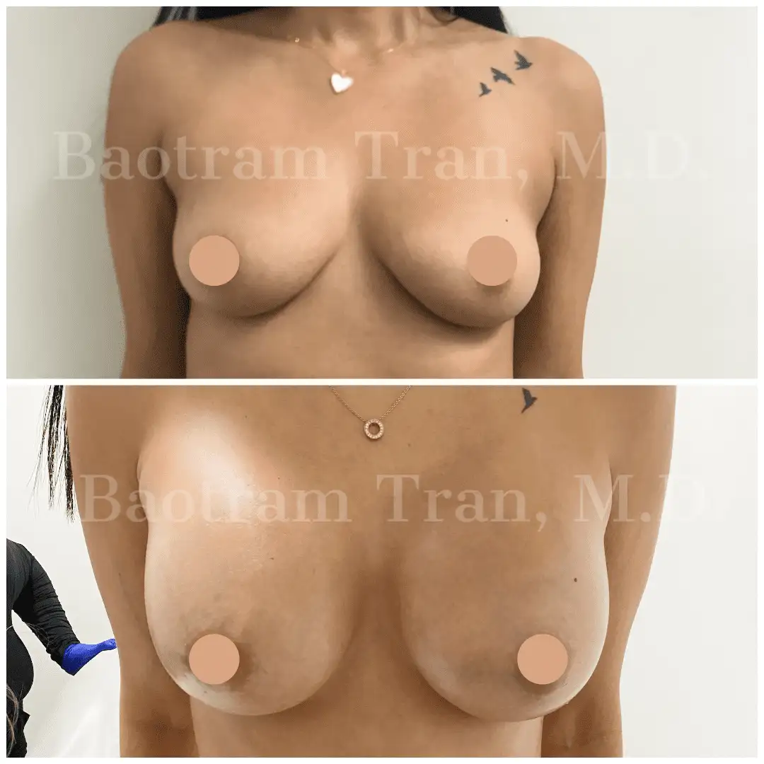 Before and After Image: Breast Augmentation - front