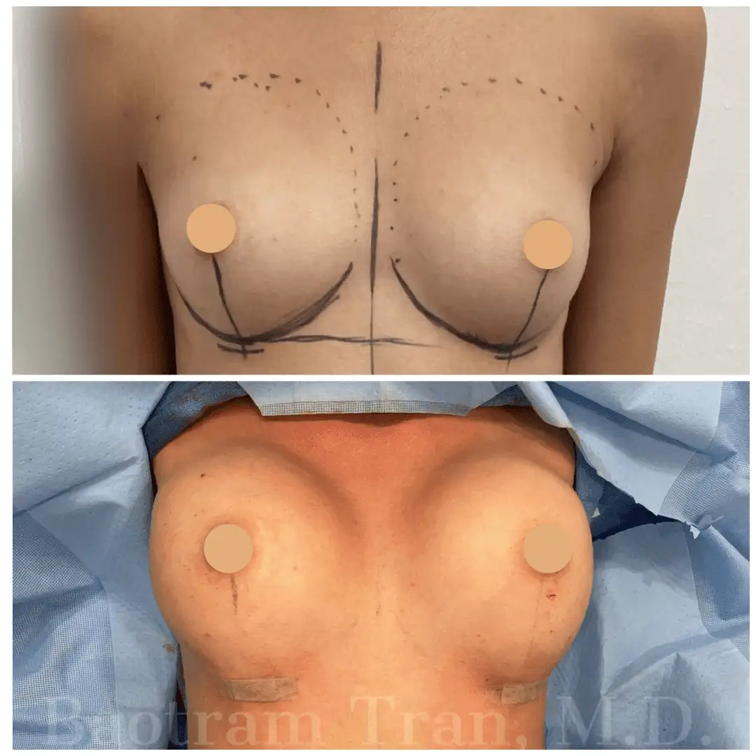 Before and After Image: Breast Augmentation - front