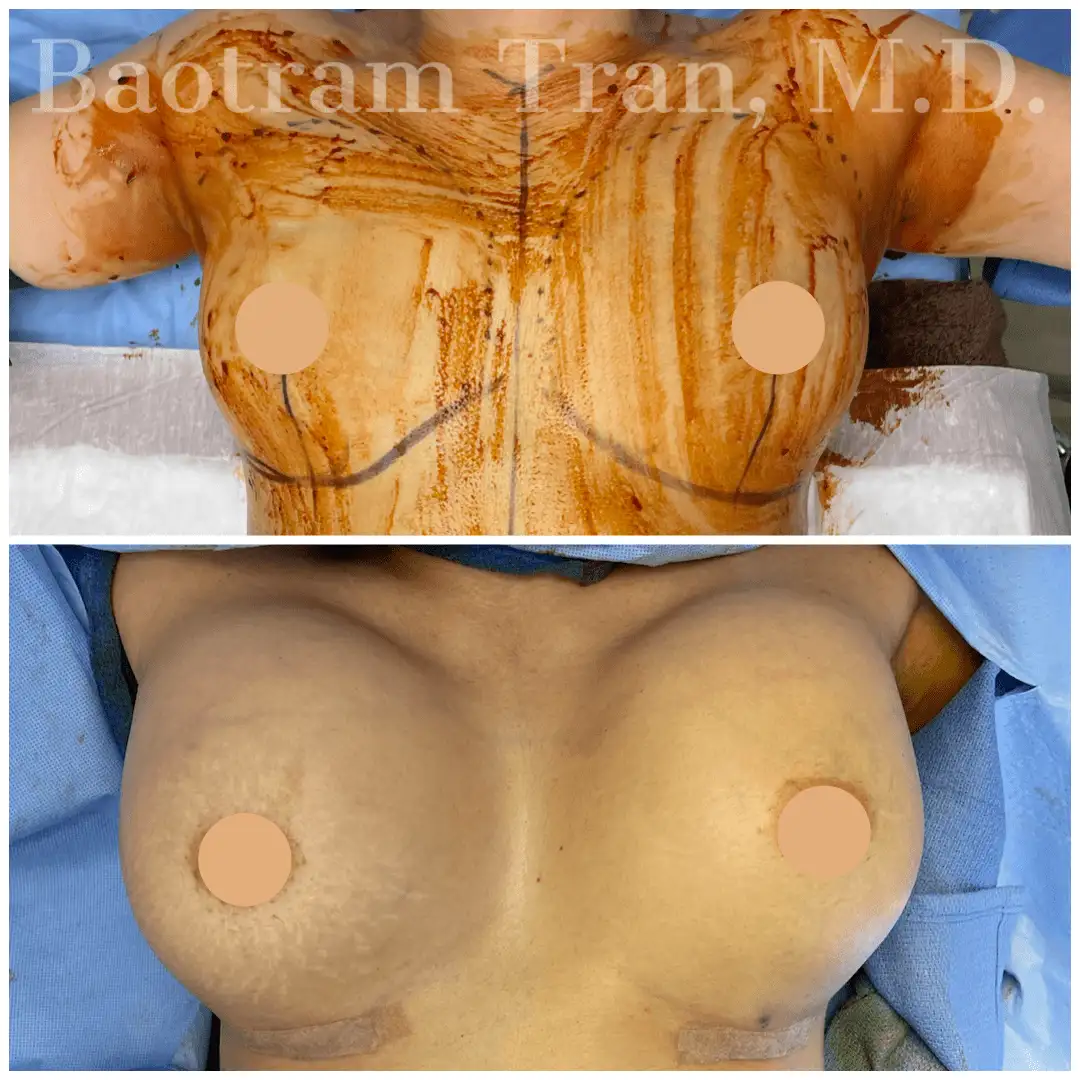 Before and After Image: Breast Augmentation - front
