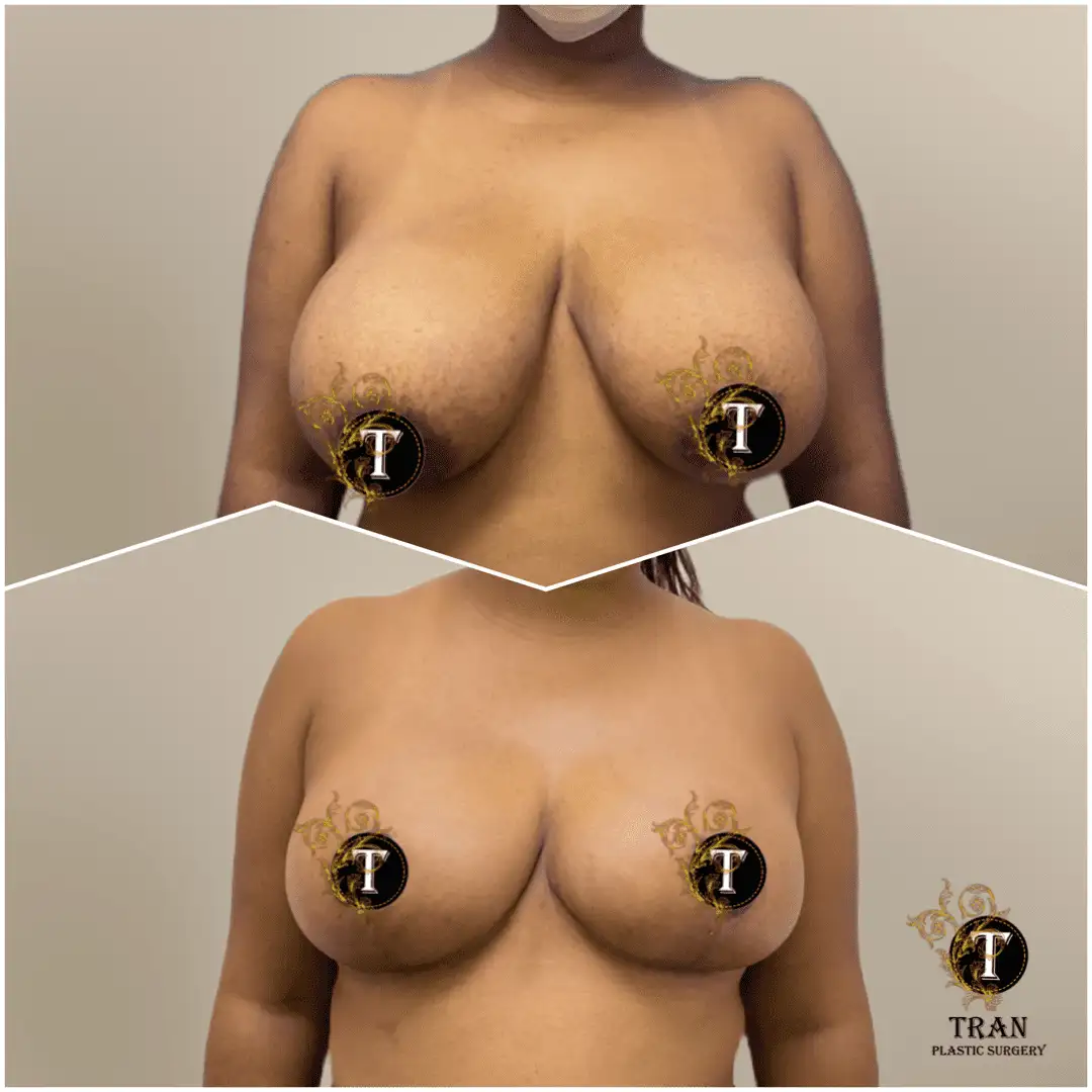 Before and After Image: Breast Lift Without Implant - front