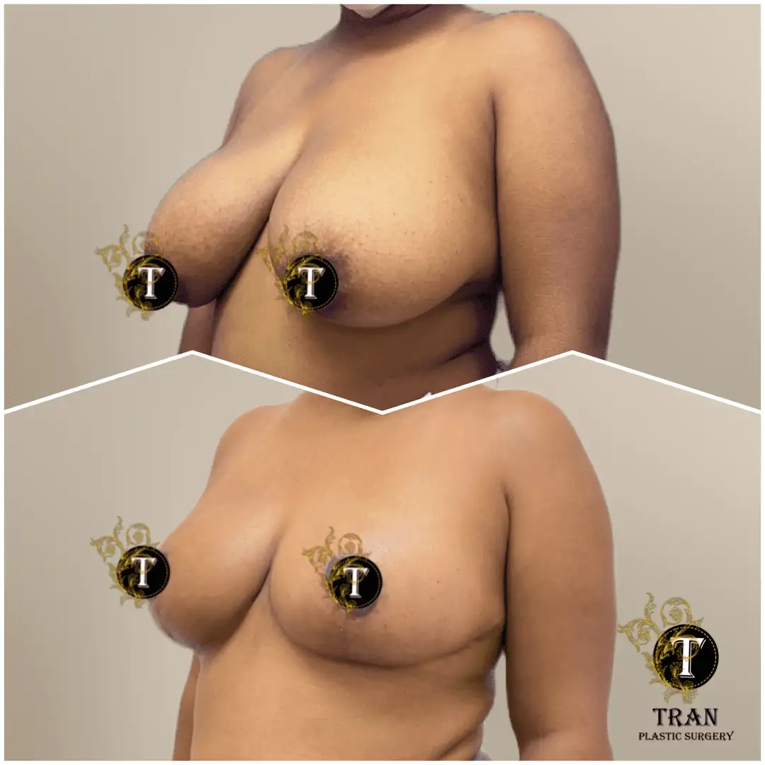Before and After Image: Breast Lift Without Implant - left-front-oblique