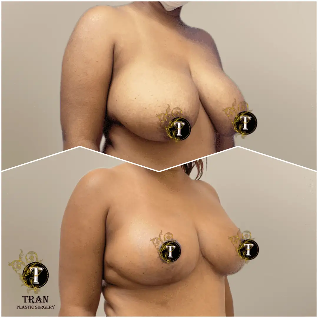 Before and After Image: Breast Lift Without Implant - right-front-oblique