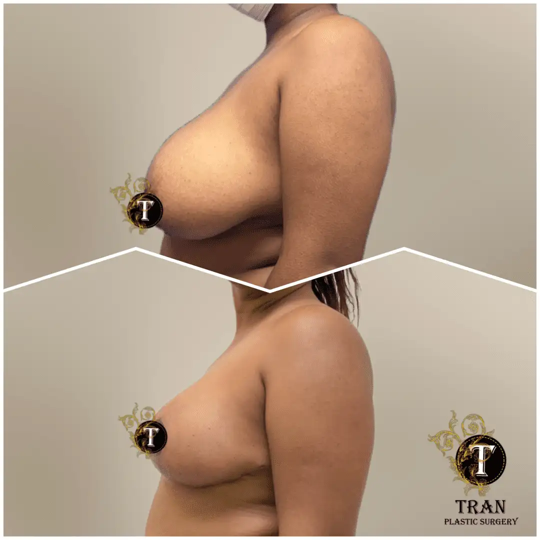 Before and After Image: Breast Lift Without Implant - left-side