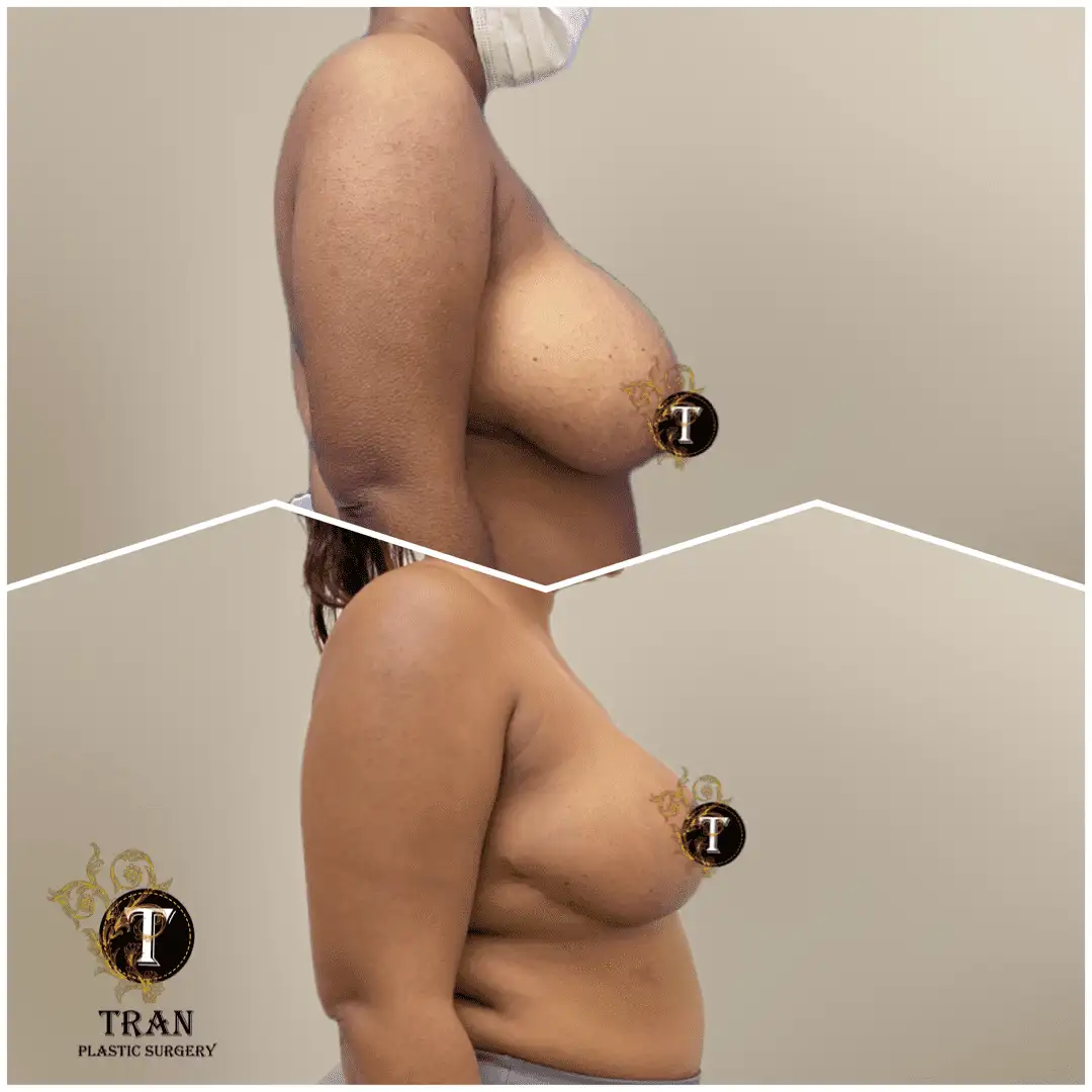 Before and After Image: Breast Lift Without Implant - right-side