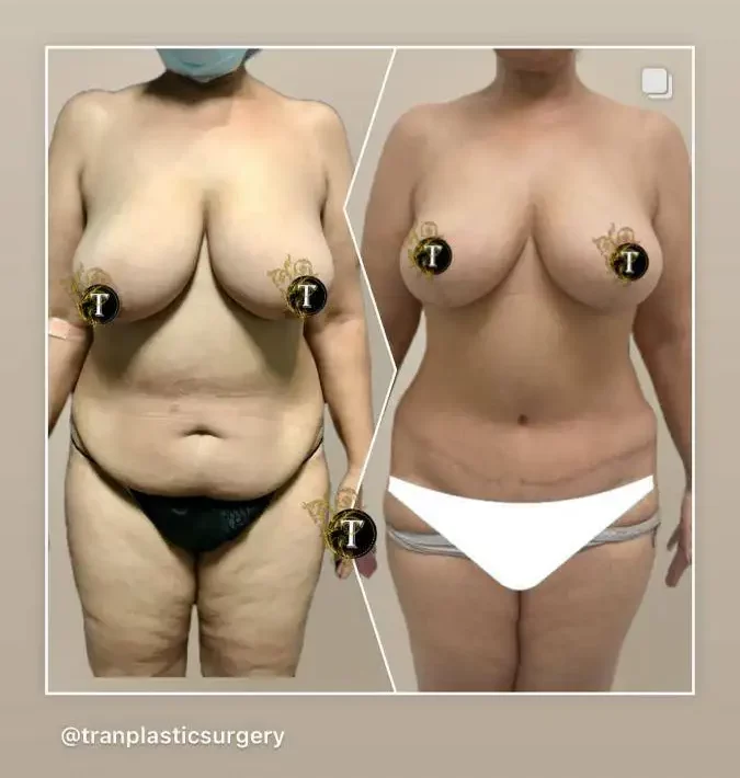 Before and After Image: Breast Lift Without Implant - front