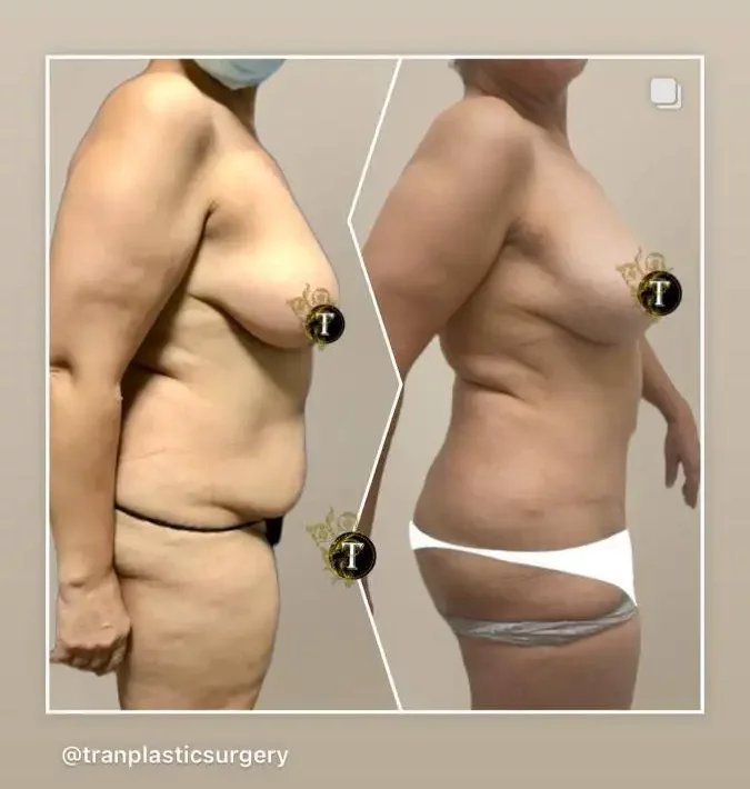 Before and After Image: Breast Lift Without Implant - right-side