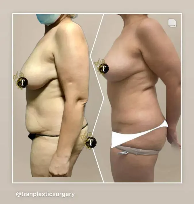 Before and After Image: Breast Lift Without Implant - left-side