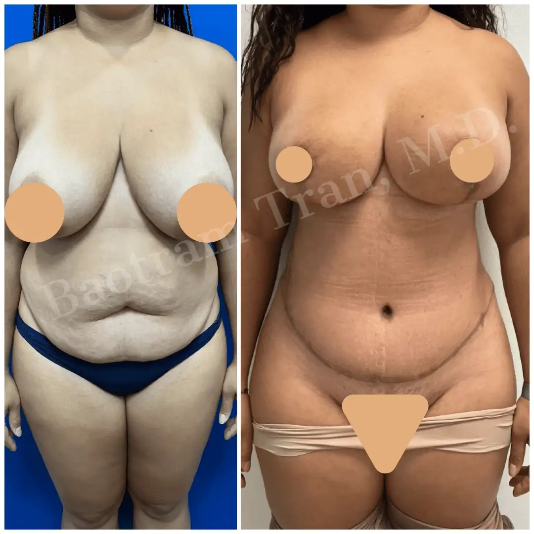 Before and After Image: Breast Lift Without Implant - front