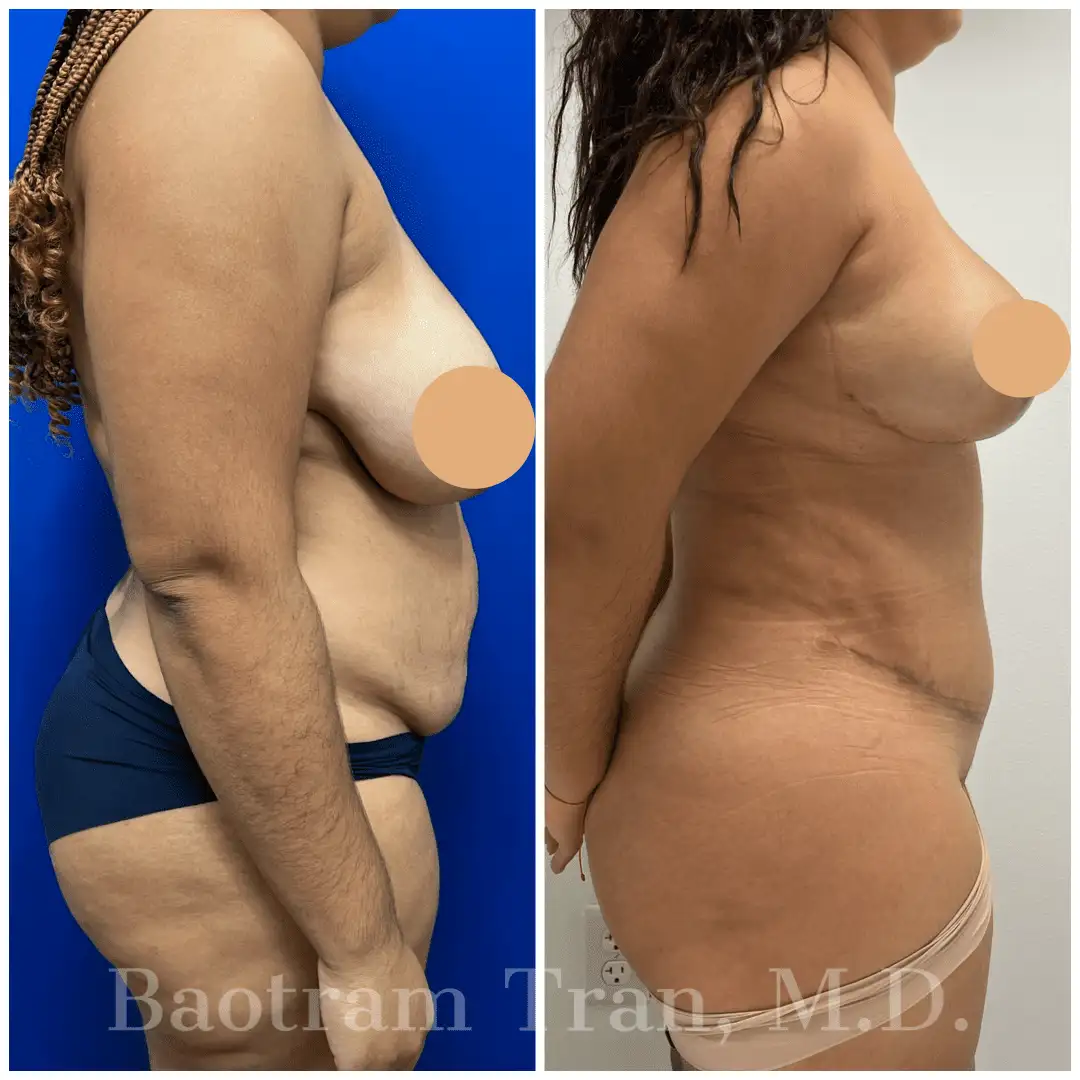 Before and After Image: Breast Lift Without Implant - right-side