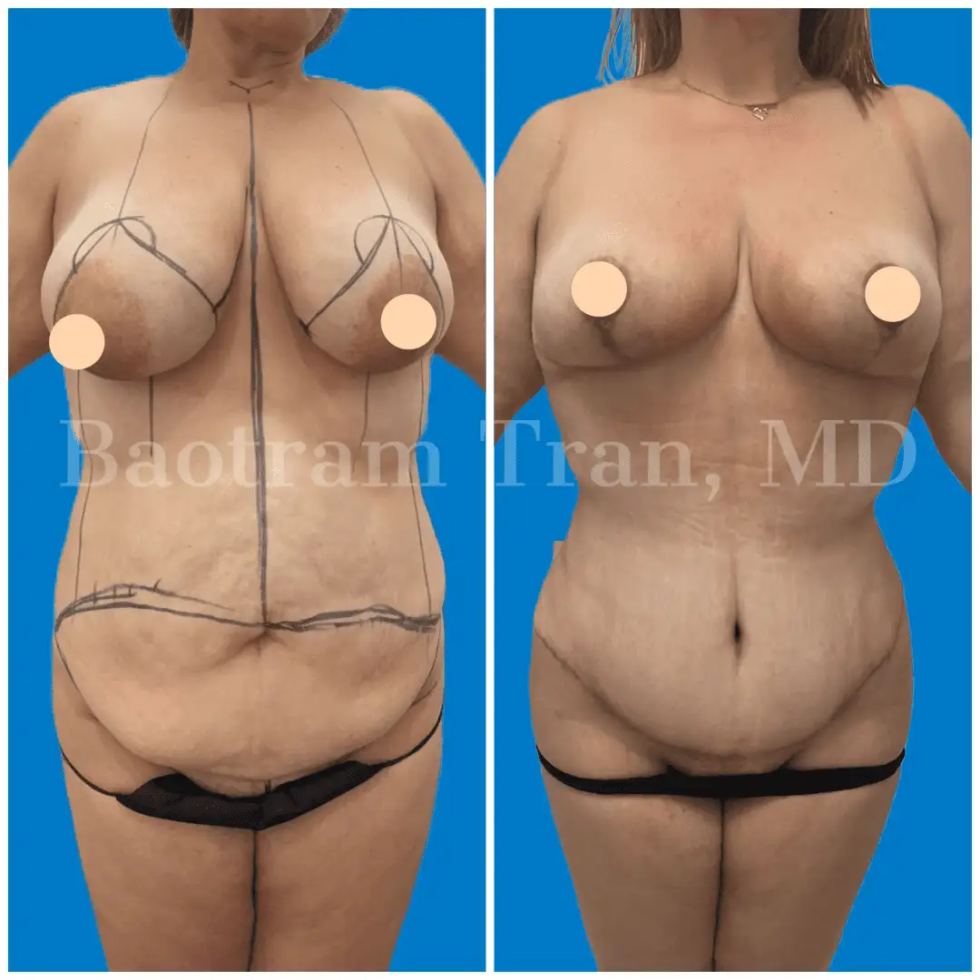 Before and After Image: Breast Lift Without Implant - front