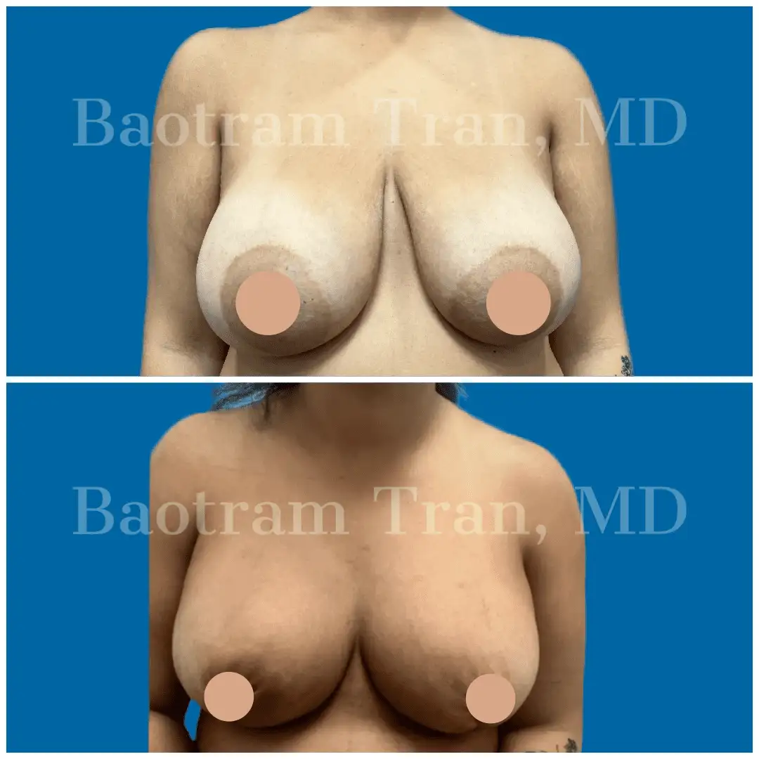 Before and After Image: Breast Lift Without Implant - front