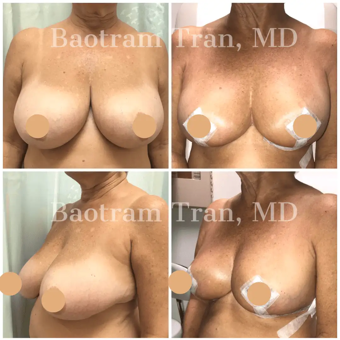 Before and After Image: Breast Lift Without Implant - front