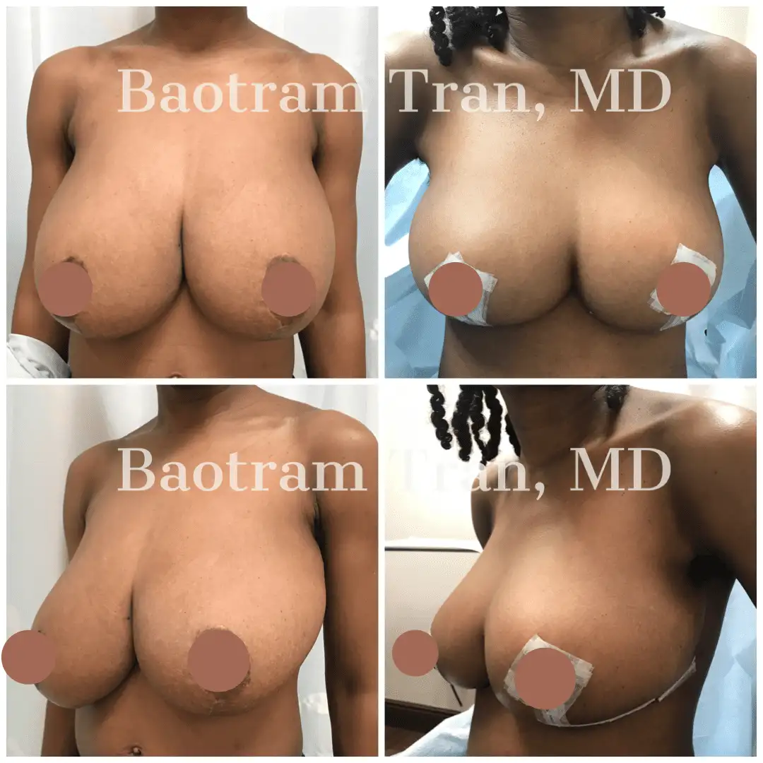 Before and After Image: Breast Lift Without Implant - front