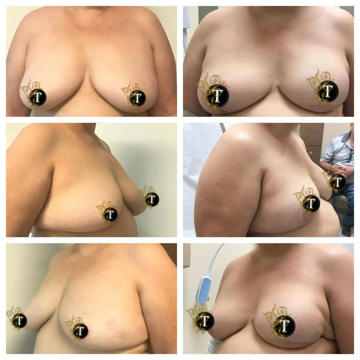 Before and After Image: Breast Reconstruction - front
