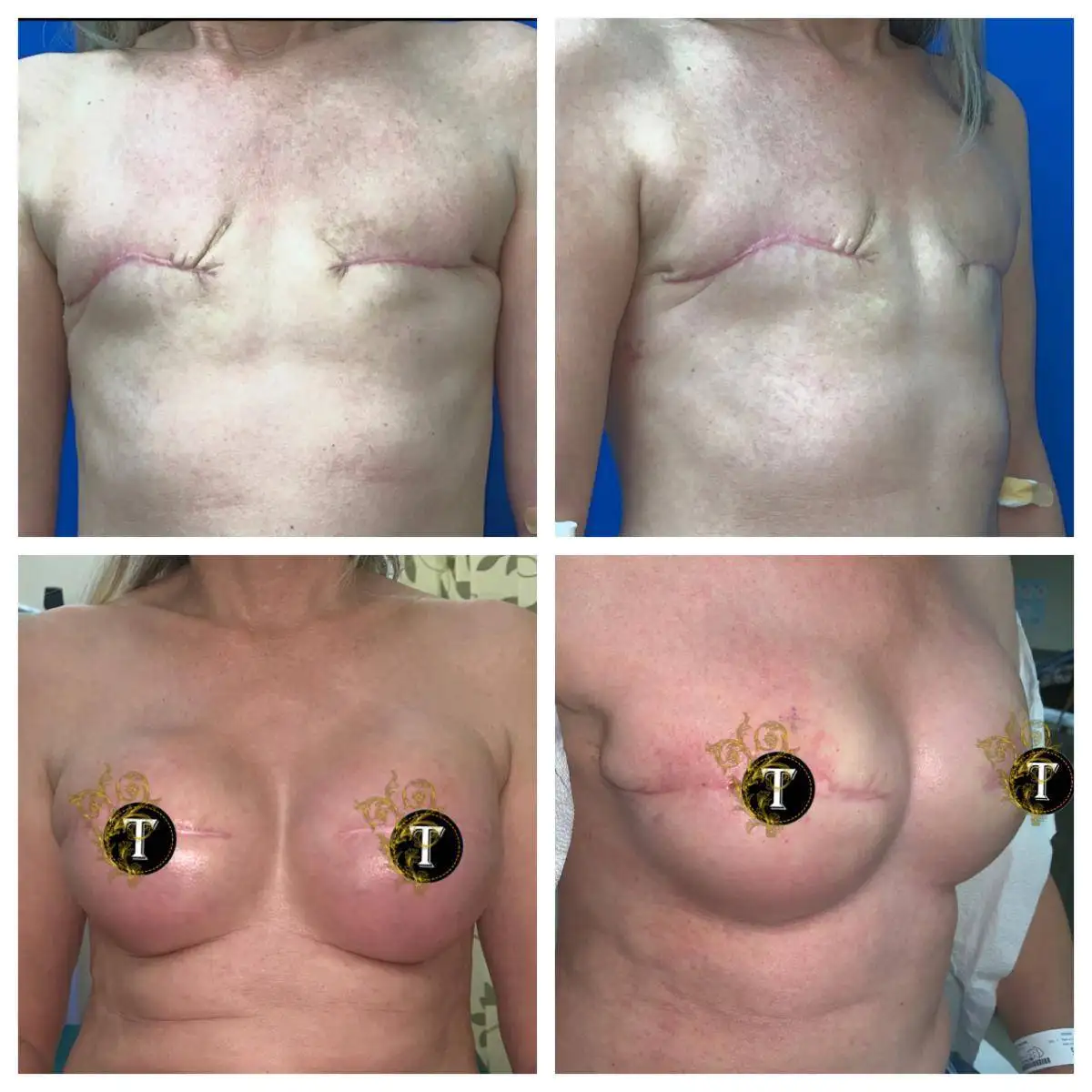 Before and After Image: Breast Reconstruction - front
