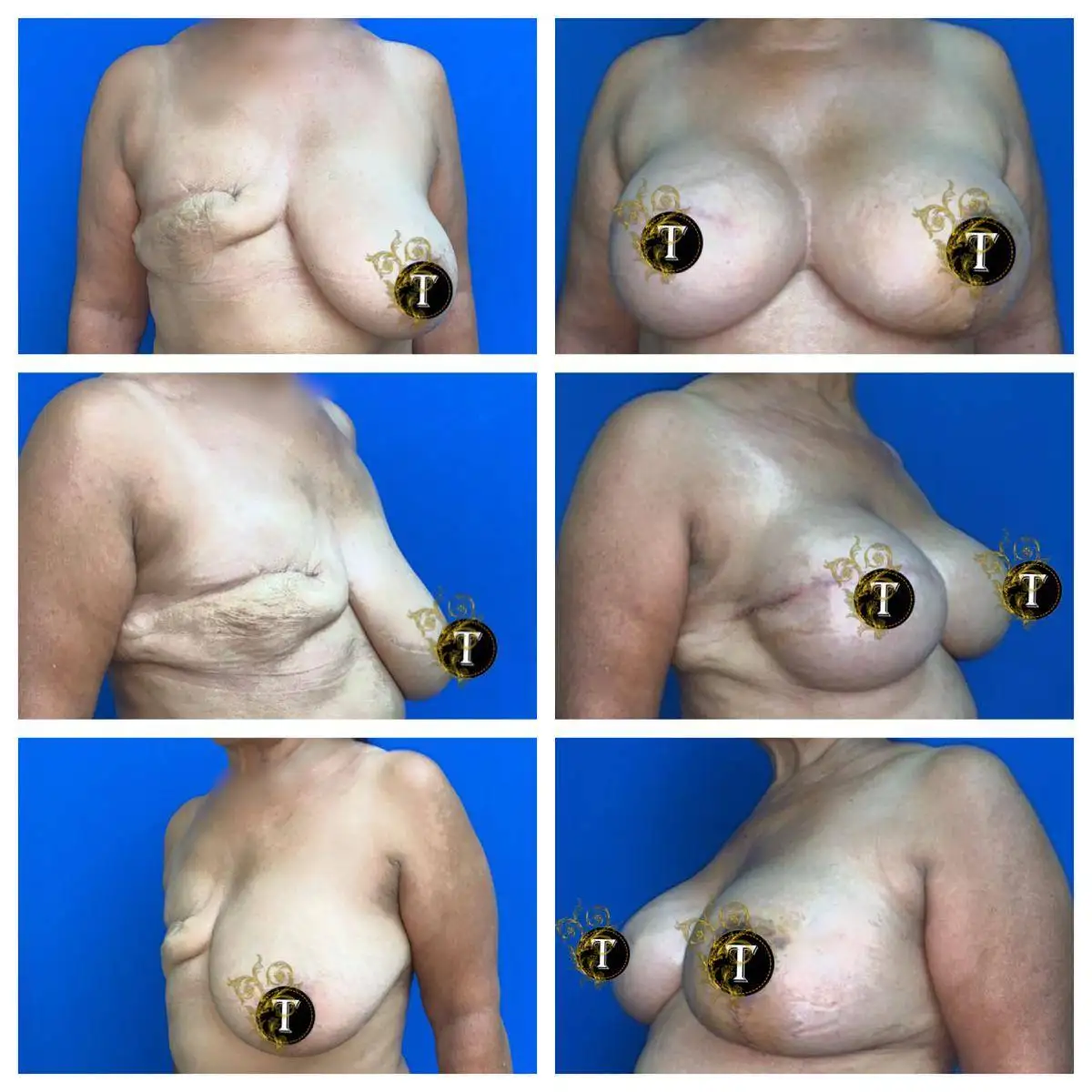 Before and After Image: Breast Reconstruction - front