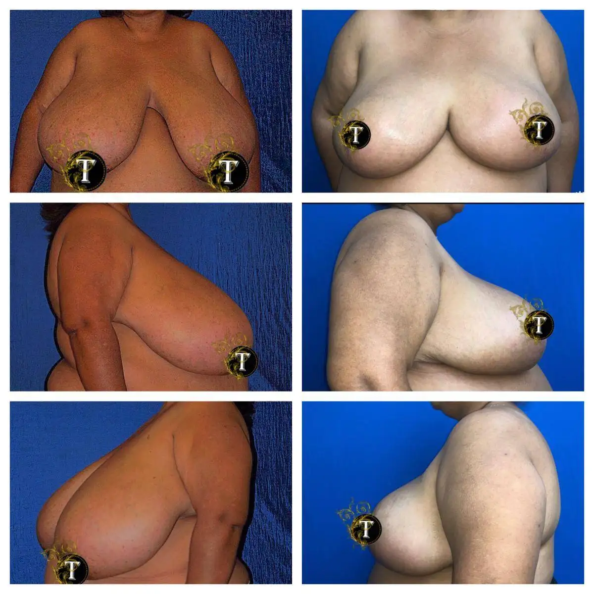 Before and After Image: Breast Reduction - front