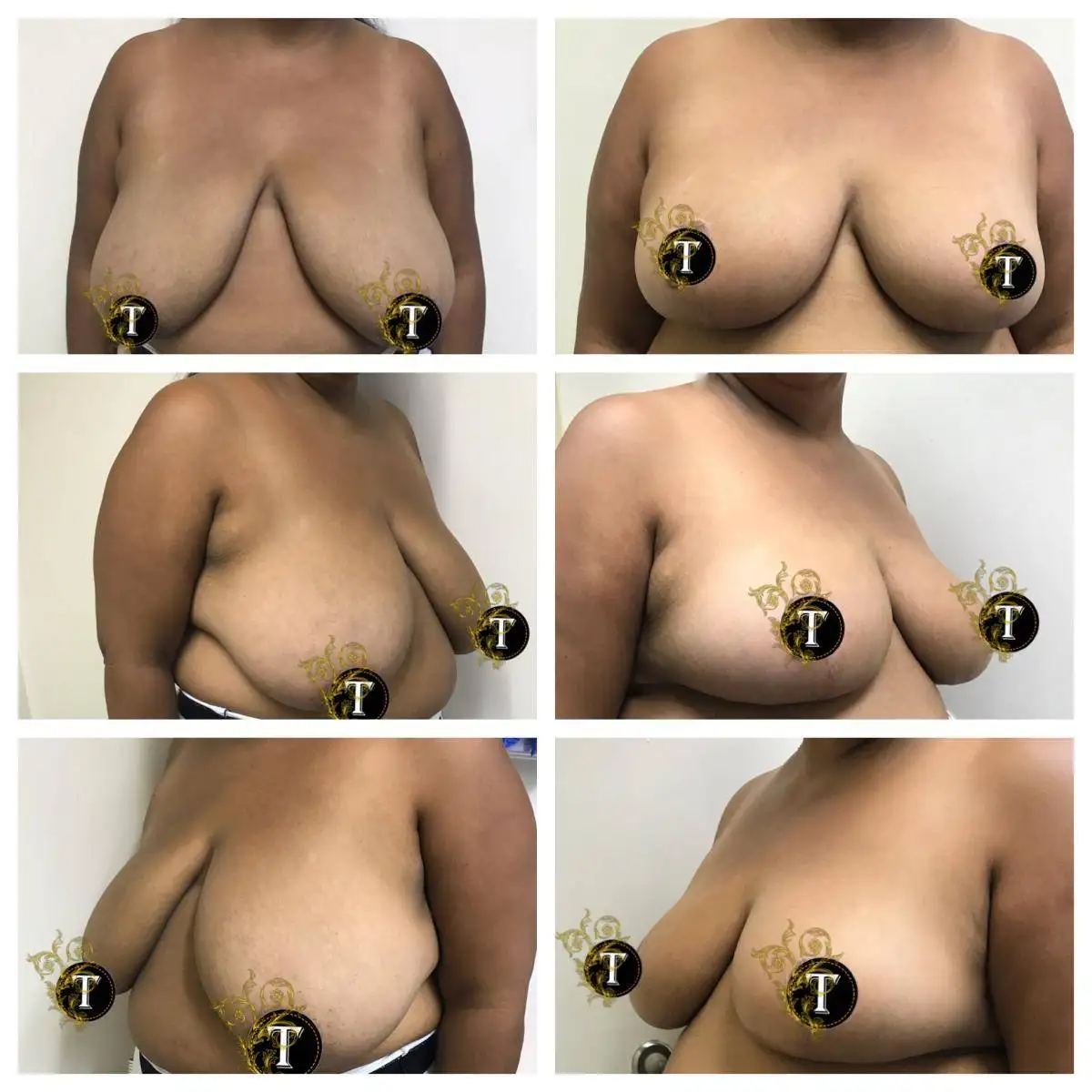 Before and After Image: Breast Reduction - front