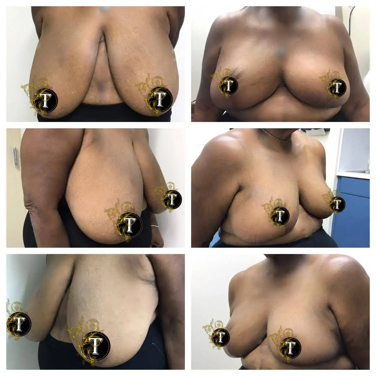 Before and After Image: Breast Reduction - front