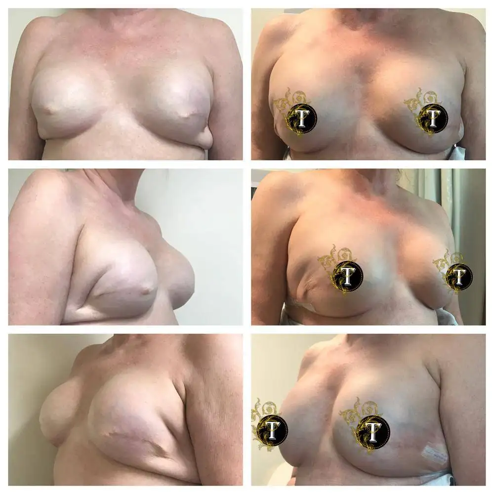 Before and After Image: Breast Revision - front