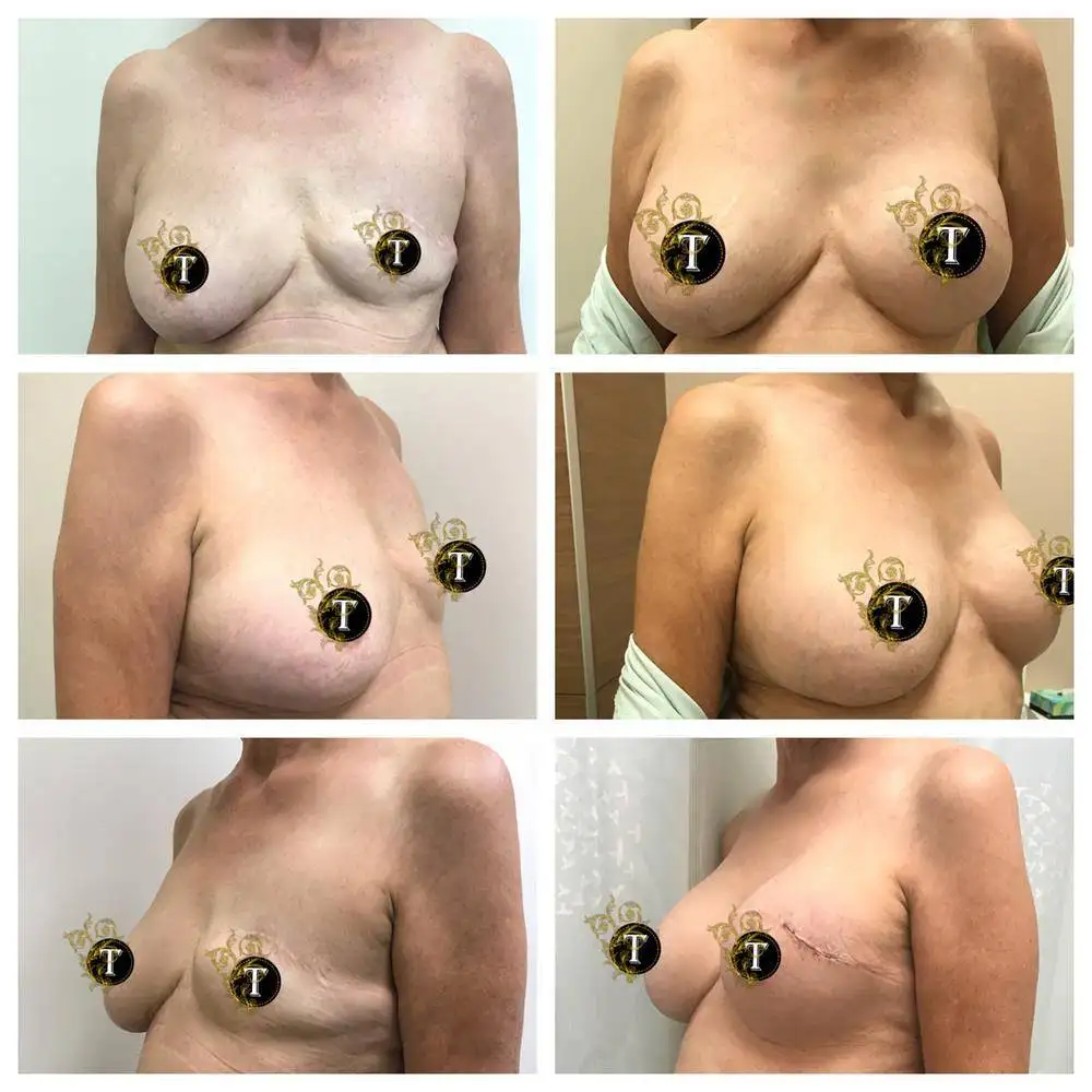 Before and After Image: Breast Revision - front