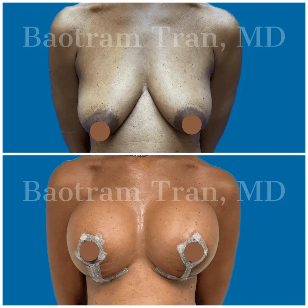 Before and After Image: Breast Lift with Implant - front
