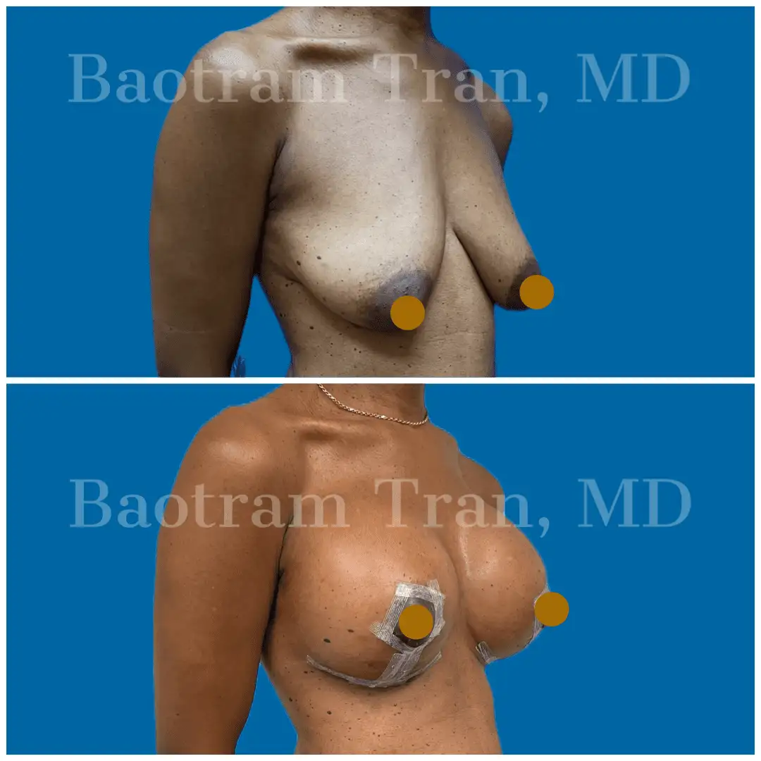 Before and After Image: Breast Lift with Implant - right-front-oblique