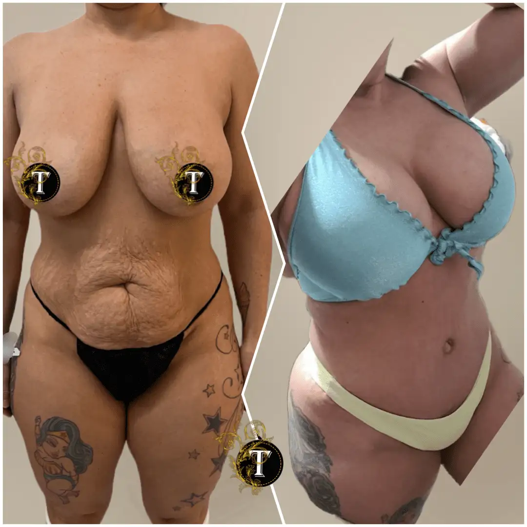 Before and After Image: Breast Lift with Implant - front