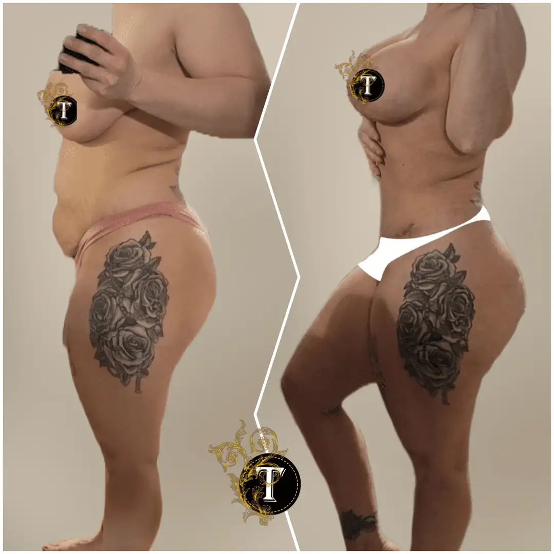 Before and After Image: Breast Lift with Implant - left-side