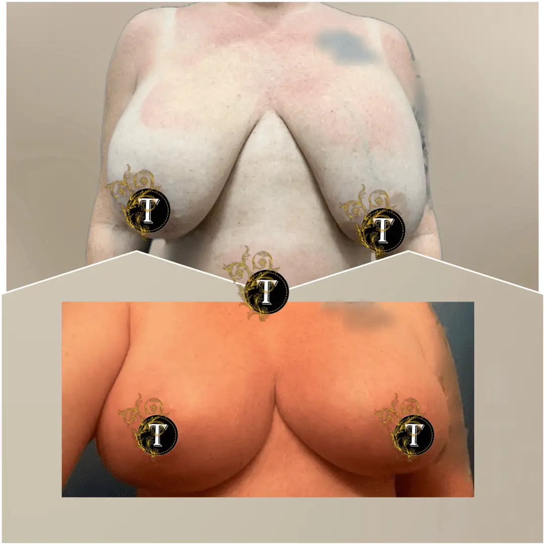 Before and After Image: Breast Lift with Implant - front