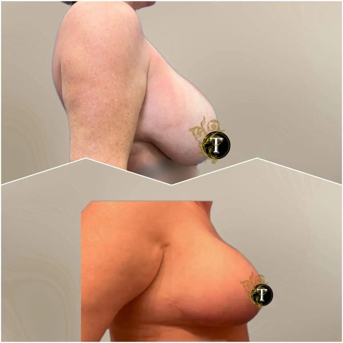 Before and After Image: Breast Lift with Implant - right-side